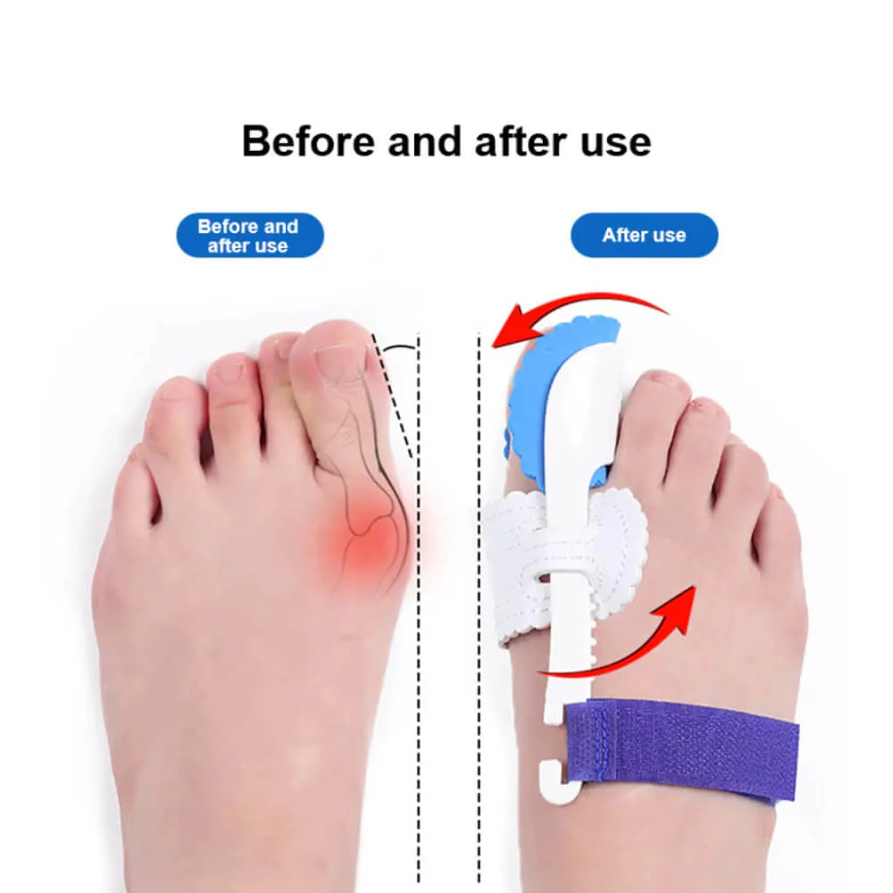 Bunion Corrector for Men & Women